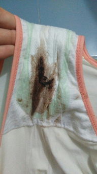 12岁女孩以为月经不调，竟查出癌症晚期：胃癌年轻化的警示