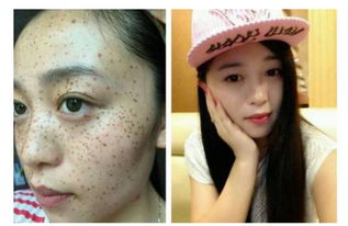 你脸上的斑是哪一种？揭开色斑的神秘面纱