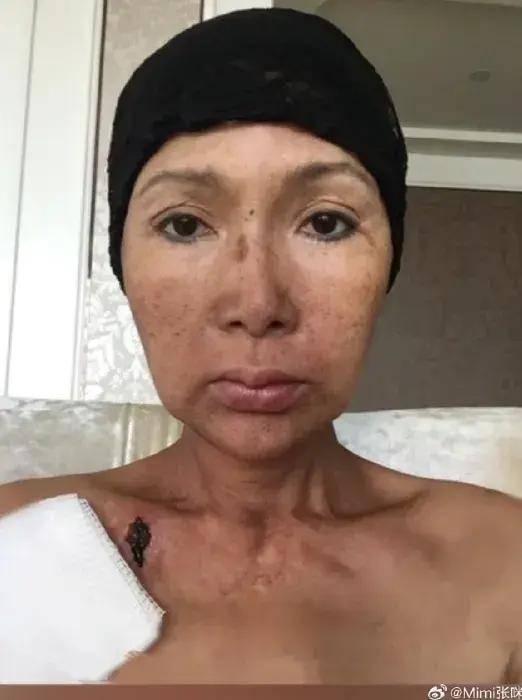 张咪抗癌归来：切除半个舌头后，她重新找到了声音