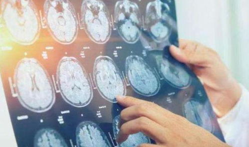 印度暴发罕见神经系统疾病疑已致5死：一个亲历者的观察