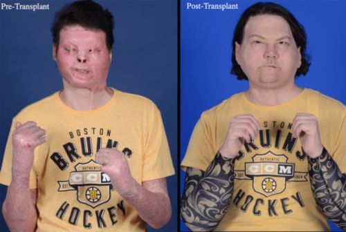 全球首例同时换脸换手男子的婚礼：爱与奇迹的结合