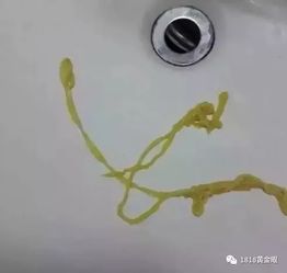 男子体内惊现2.73米绦虫，背后真相令人不寒而栗！