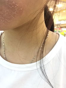 秋冬季节下巴干燥起皮？他用亲身经历告诉你如何解决