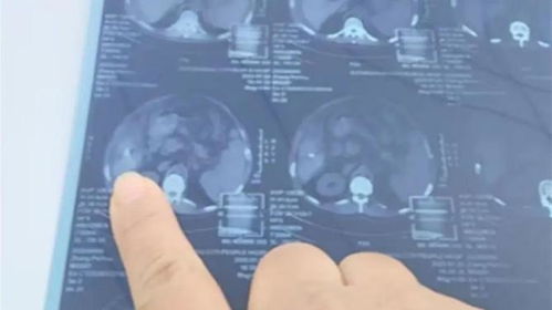 15毫米针头留体内30天，我的父亲经历了怎样的痛苦与挣扎