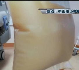 饭后肚子剧痛，男子体内抽出“牛奶血”，竟是高脂血症型胰腺炎！