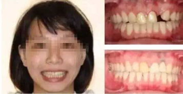 美丽微笑的秘密：为什么牙齿美白主要针对前牙？