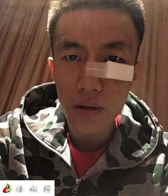 郭艾伦眼睛流血，职业精神令人动容！