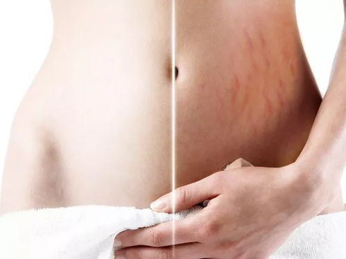 怀孕期间如何有效预防和治疗妊娠纹？