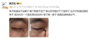 郭艾伦不会失明：球迷的担忧与真相大揭秘