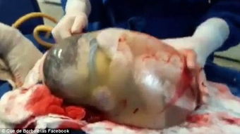 见证奇迹：带壳宝宝诞生，完整羊膜囊包裹的“水晶宝宝”