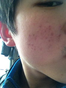 19岁小伙脸上爆痘竟是红斑狼疮，他的故事让我重新认识了这种“美女病”