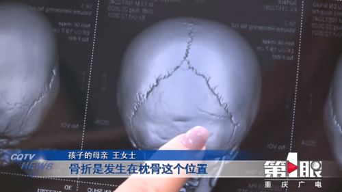 母婴店意外：半岁宝宝颅骨骨折背后的深思