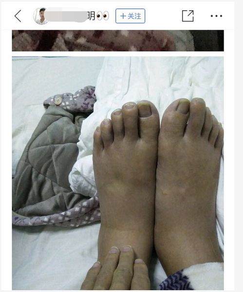 年轻生命的陨落：18岁抗癌博主晟宝的离世引发深思