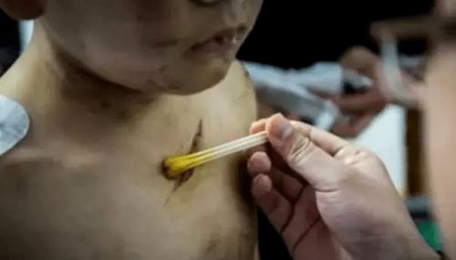 8岁男孩出手复位女宝脱位肘关节：奇迹背后的故事