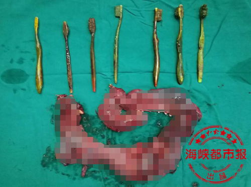 女子为催吐误吞18厘米牙刷，背后的故事令人深思