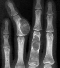 抗癌路上的告别：28岁医学生小何的最后旅程