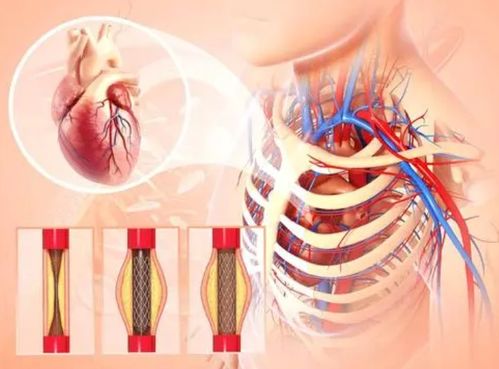 心脏支架手术真的要被淘汰了吗？真相在这里！
