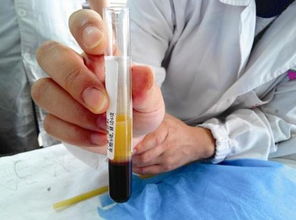 52岁妇女抽血浆后突发脑梗死：家属发声还原事件真相