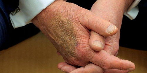 特朗普手背淤青引热议：握手太多还是另有隐情？