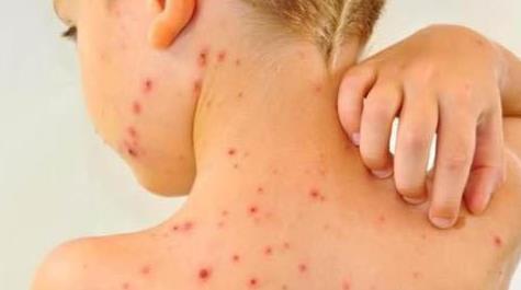 只有小孩才会得水痘？它悄悄长在这个部位，中老年人有苦难说