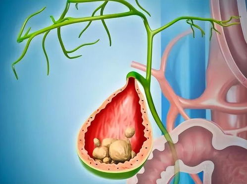 无癌却被切胆囊：一场医疗争议背后的真相