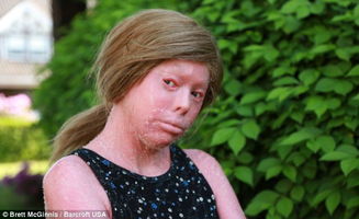 22岁女孩患罕见病全身似烧伤：她的坚强让我重新认识生命的意义