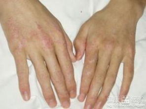 与白塞病共舞：一位患者的自我救赎之路