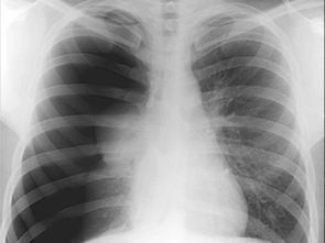 气胸是什么？从我的亲身经历告诉你这个“隐形杀手”有多可怕