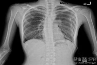 气胸到底是什么病？听他亲身经历后的深刻解读