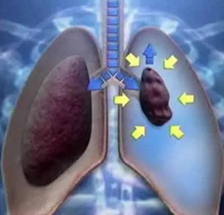 警惕气胸！三类人要注意，别让健康“漏气”