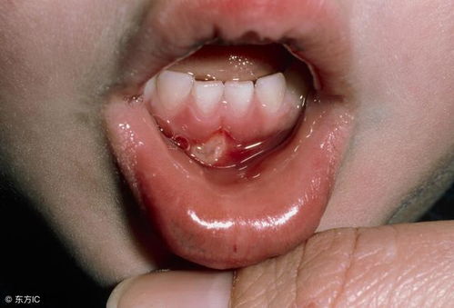 灼口综合症：不是上火，而是隐藏的健康信号