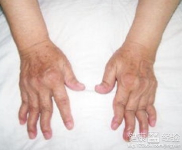 关节健康的守护者：成都附大类风湿医院的诊疗新突破