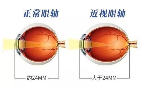 高度近视患者超1.3亿，为何我国近视问题如此严重？
