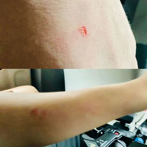 手肘受伤后的那些日子：一次意外带来的深刻反思