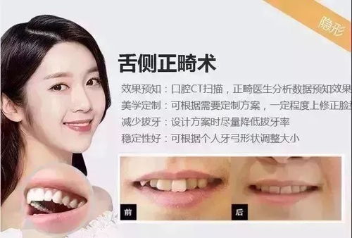 嘴凸真的只能靠矫牙解决吗？一个真实经历者的思考