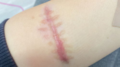 从伤痕到光滑肌肤：他用这些方法成功消除疤痕