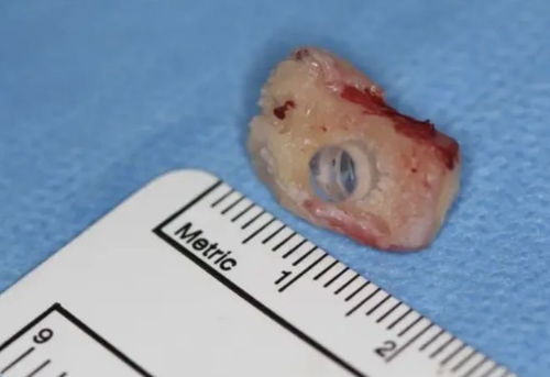 加拿大首例“以牙换眼”手术：见证奇迹的诞生