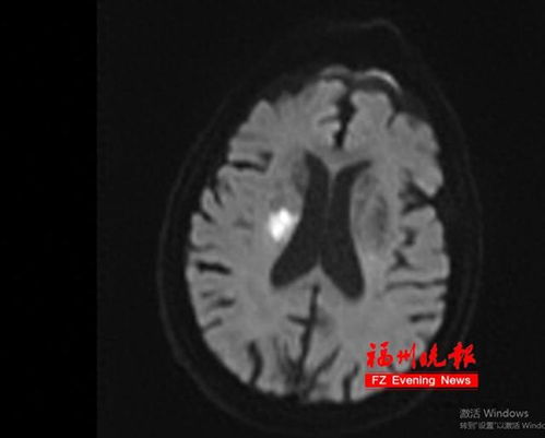 感冒后硬扛？福州男子突发脑梗死，医生提醒这些行为要避免