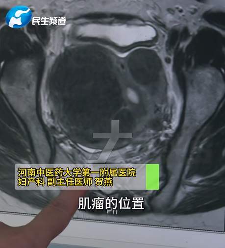 26岁女子因生闷气导致子宫长出8个肌瘤，生气真的会「气出肌瘤」吗？