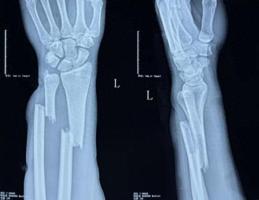 男子骨折手部变形 中医正骨几秒复位的神奇瞬间