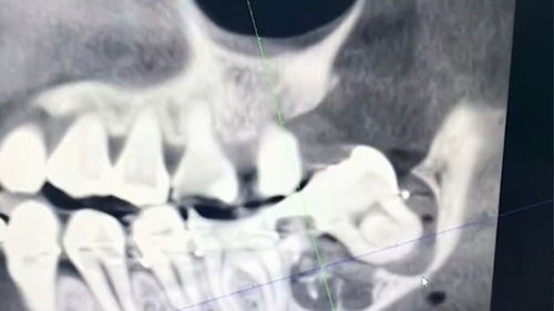 被拔错牙坠亡女子家属与相关方和解：一场悲剧背后的反思