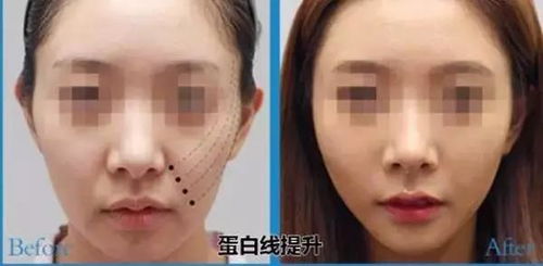 女子线雕手术三年后脸上钻出一根线，真相令人不寒而栗