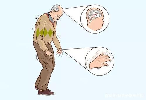 帕金森早期那些隐匿症状如何察觉？他的故事告诉你答案