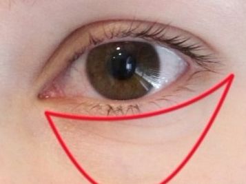 告别眼袋困扰，重拾眼部光彩