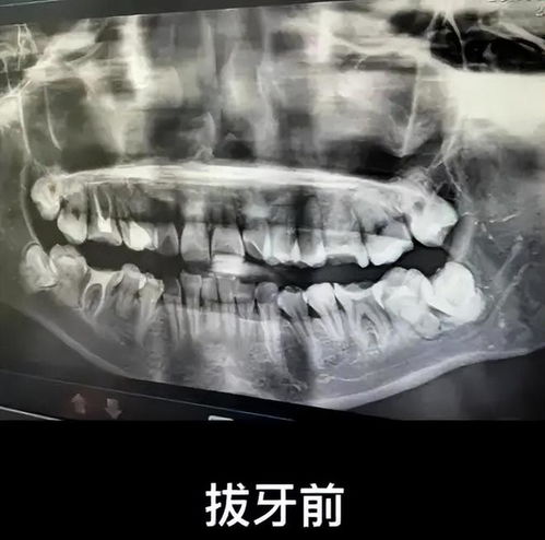 女子拔牙后坠亡事件后续：真相与反思