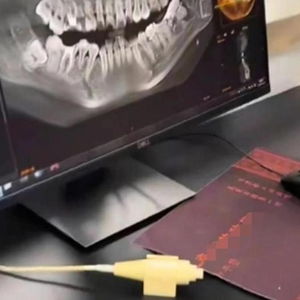 女子拔错牙后坠亡事件：涉事医生被停诊，真相仍待揭开