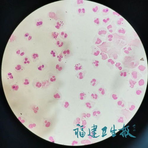 男子以为感冒硬撑3天后被送进ICU：我们真的了解“小病”的危险吗？