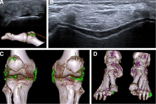 CT查出骨折却被告知没骨折，背后真相让人深思