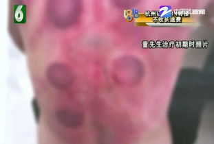 拔罐着火事件背后：一场关于责任与安全的深刻反思