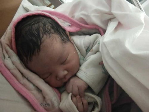 张檬孕37周迎剖腹产：胎儿臀位绕颈，切口近14厘米！